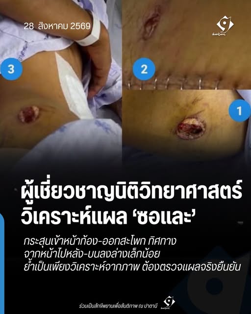 ผู้เชี่ยวชาญนิติวิทยาศาสตร์วิเคราะห์แผลซอและ กระสุนเข้าหน้าท้อง-ออกสะโพก